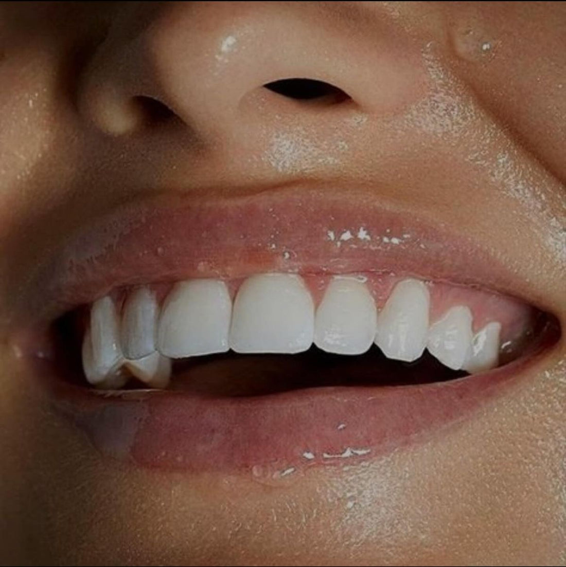 Stralende glimlach met zichtbaar wittere tanden na teeth whitening