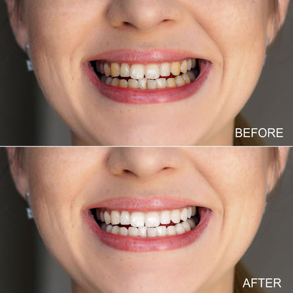 Voor en na resultaat van LucidBite whitening strips – zichtbaar wittere tanden zonder gevoeligheid